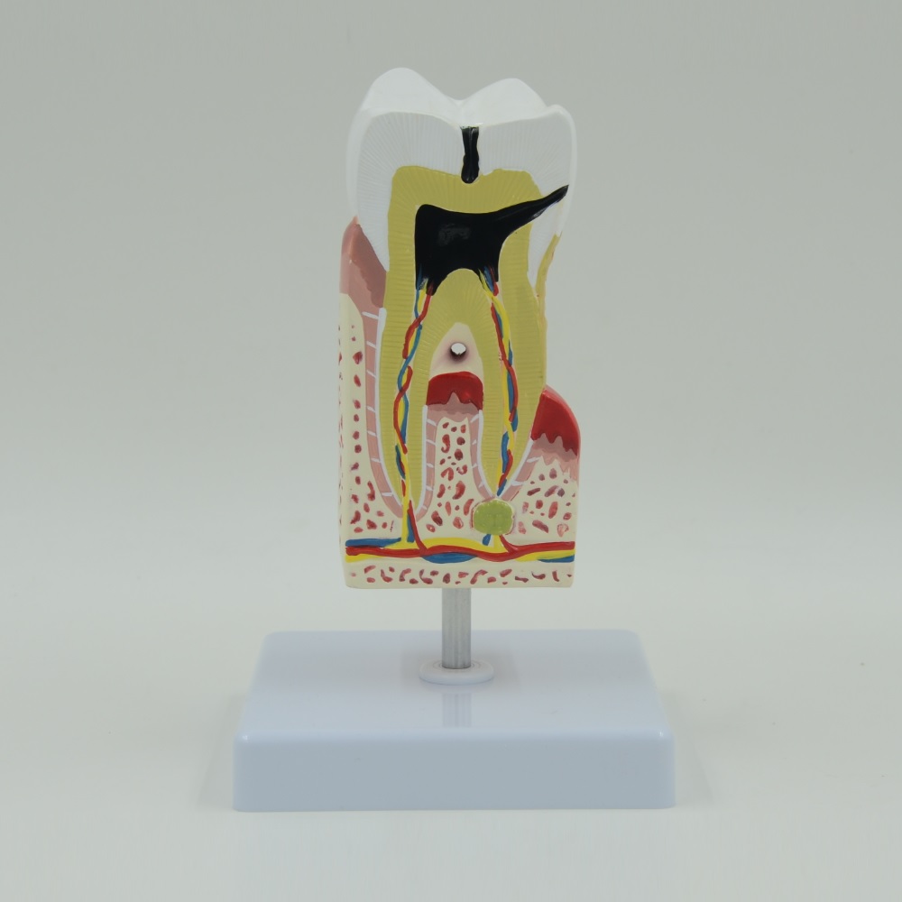 Disease Tooth Model 10x - why.gr